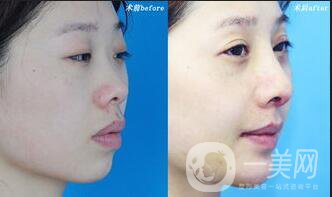 墊鼻基底后遺癥,墊鼻基底術(shù)后護(hù)理