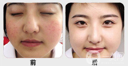 激光祛紅血絲可靠嗎?靠譜嗎?