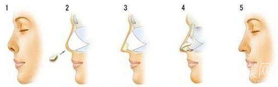 自體肋軟骨隆鼻后遺癥有些啥？