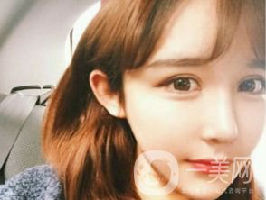 割雙眼皮多久恢復(fù)自然？