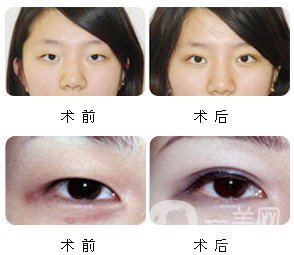 割雙眼皮多久恢復(fù)自然？