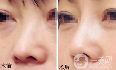 膨體隆鼻是終生的嗎？