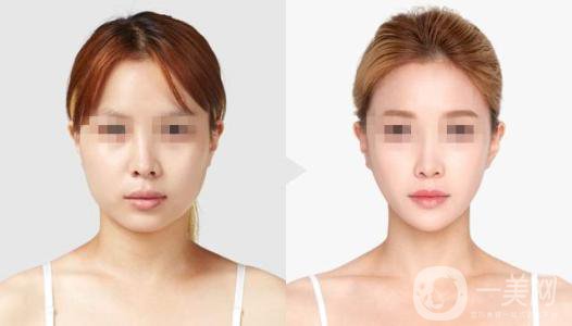 雙頜截骨術是什么 雙頜截骨術的特點