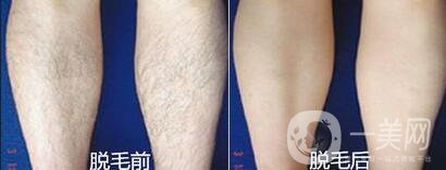 激光脫毛多少錢,激光脫毛后遺癥