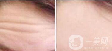 去除抬頭紋風(fēng)險,去除抬頭紋方法