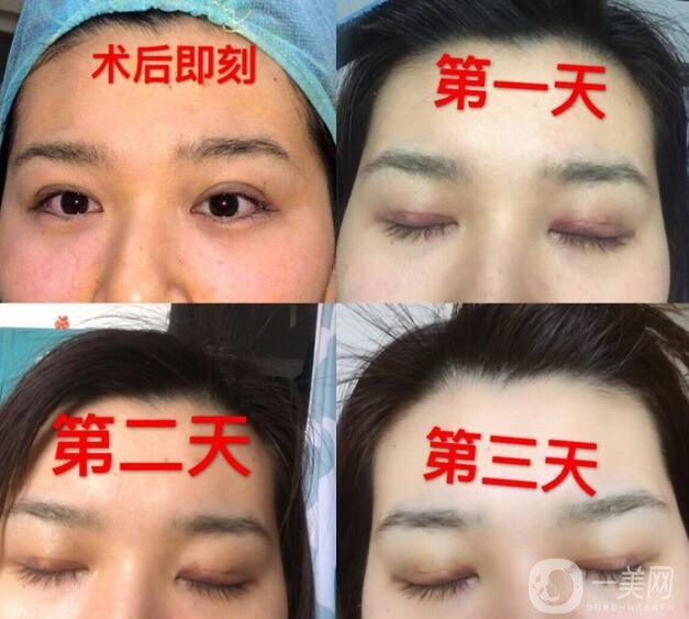 埋線雙眼皮維持幾年,納米*雙眼皮