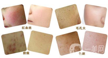 彩光嫩膚好嗎？*果如何？