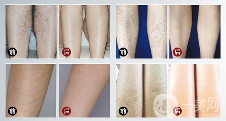 激光脫毛脫了還會長嗎？