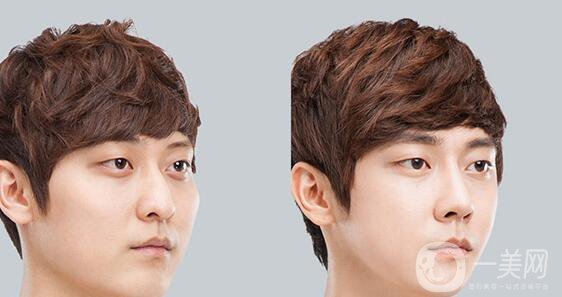 高級面部輪廓手術(shù)有哪些？