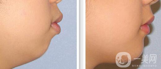 高級面部輪廓手術(shù)有哪些？