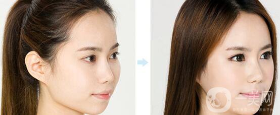 高級面部輪廓手術(shù)有哪些？