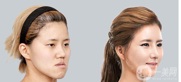 高級面部輪廓手術(shù)有哪些？