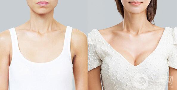 韓國(guó)假體隆胸手術(shù)