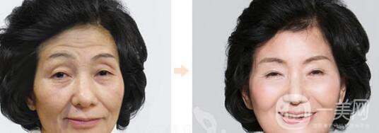 預(yù)防衰老的整形手術(shù)