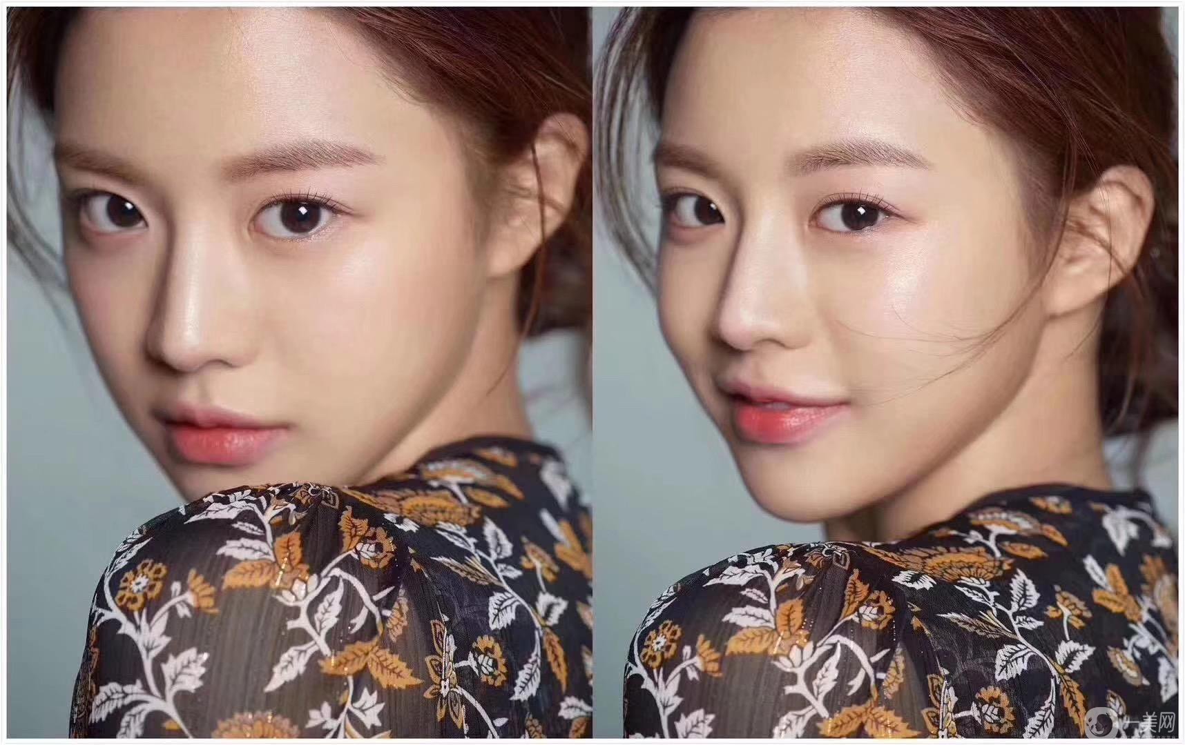 割完雙眼皮多久能化妝 如何護(hù)理能盡快恢復(fù)？