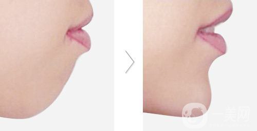 下頜骨后縮怎么矯正？矯正方法有哪些？