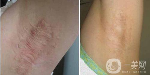 疤痕體質(zhì)怎么預防增生 疤痕體質(zhì)要注意什么