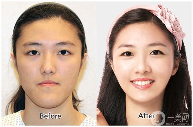 下頜后縮會(huì)不會(huì)遺傳呢 下頜后縮可以調(diào)節(jié)嗎