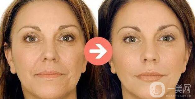 瑞藍玻尿酸保持多久,瑞藍玻尿酸詳細介紹 