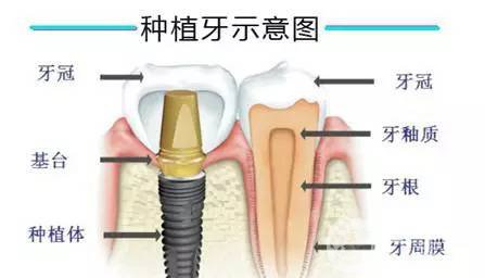 人工種植牙齒價(jià)格 手術(shù)費(fèi)用多少錢？