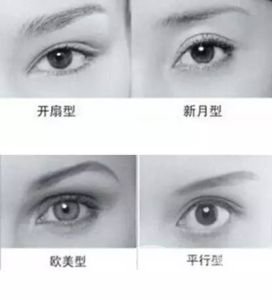 全切雙眼皮多久自然 手術(shù)有年齡限制嗎？