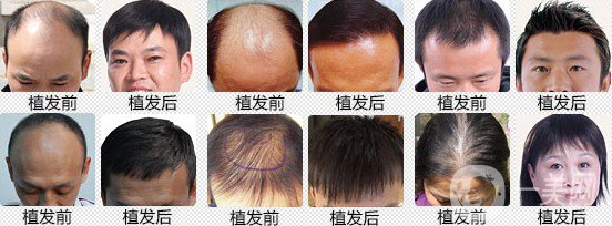 植發(fā)費用多少錢 價格高不高？