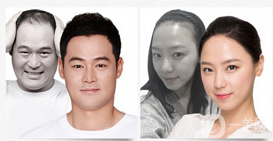 植發(fā)費用一般是多少？植發(fā)前后