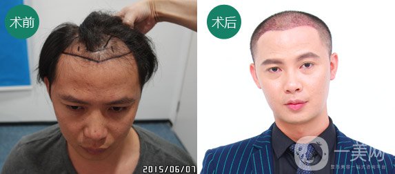 植發(fā)費用一般是多少？植發(fā)前后