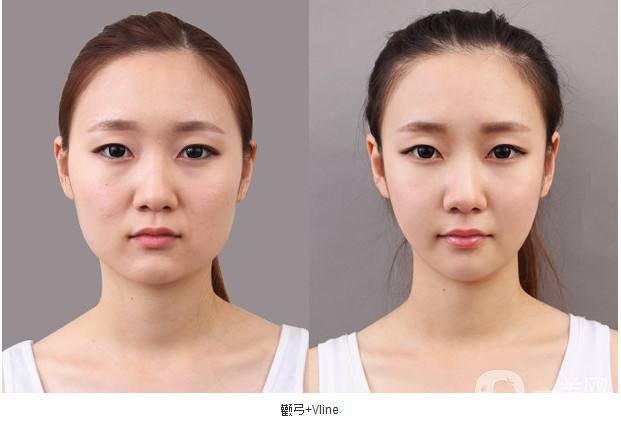 面部整形：打造精致優(yōu)雅的*面孔