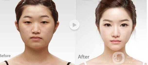 *手術后幾天恢復 手術恢復過程