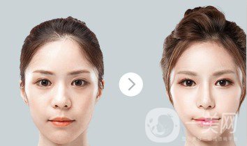 自體肋軟骨隆鼻危害有哪些？隆鼻價(jià)格