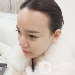 植發(fā)半年后案例 植發(fā)怎么樣？