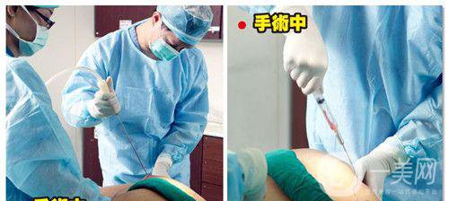 什么是抽脂手術(shù)？*果好嗎？