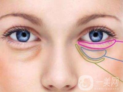 *去眼袋的副作用 會(huì)反彈嗎