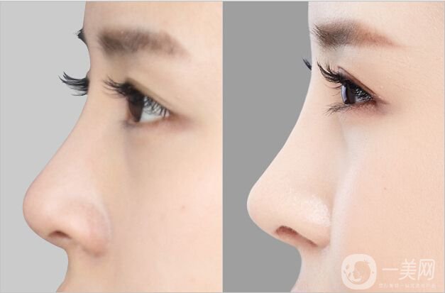 自體肋軟骨隆鼻的價(jià)位 