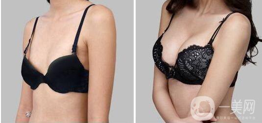 什么是乳房再造手術(shù) 乳房再造手術(shù)的原因