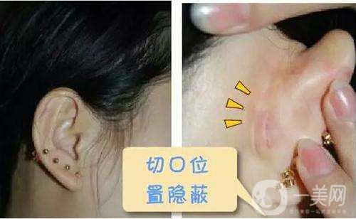 耳軟骨*后遺癥 耳軟骨*手術(shù)費(fèi)用