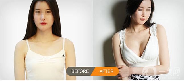 乳房下垂的診斷方法