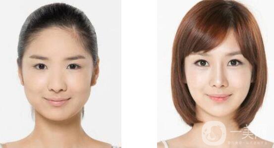 下頜角手術恢復期是多久