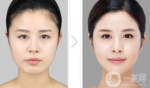 下頜角削骨多久恢復 下頜角削骨有危害嗎