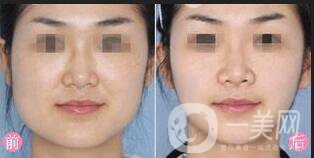 下頜角術(shù)后戴多久頭套,下頜角術(shù)后飲食,下頜角術(shù)后注意事項(xiàng)