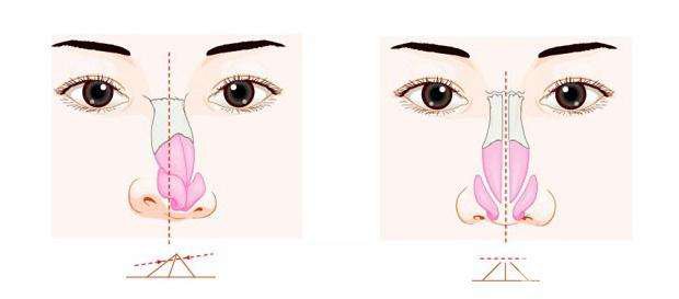 什么是偏鼻矯正手術(shù) 哪些人適合做鼻矯正手術(shù)