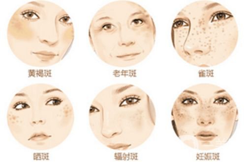 激光去斑的副作用 激光祛斑要注意哪些