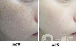 c8祛斑一般需做幾次,c8祛斑多少錢