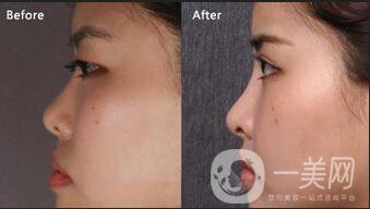 耳軟骨隆鼻能保持多久,耳軟骨隆鼻多少錢