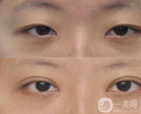 開眼角,開眼角*果