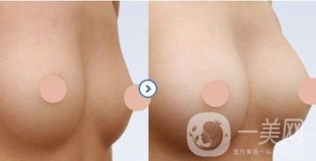 硅膠隆胸怎么樣？硅膠隆胸恢復期多久？