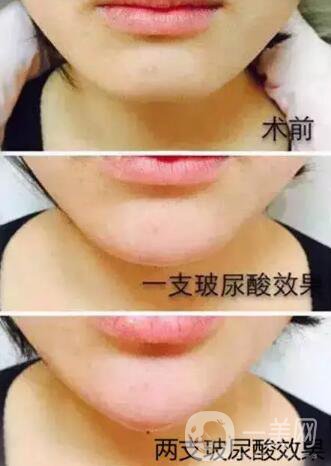 玻尿酸豐下巴需要幾針？?jī)舍槻Ｄ蛩嵯掳?果圖
