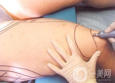 大腿抽脂需要多久恢復正常呢