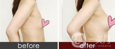 假體隆胸后遺癥